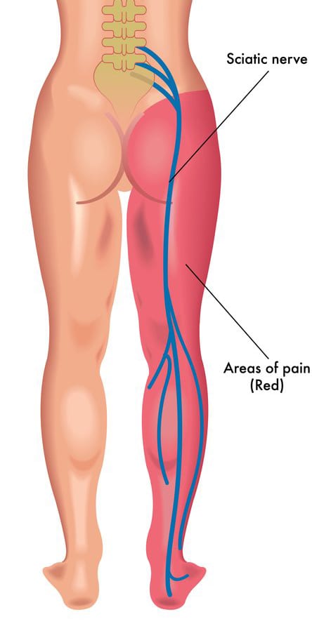 sciatic pain in leg