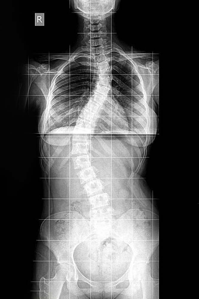 Spine Curve X-ray