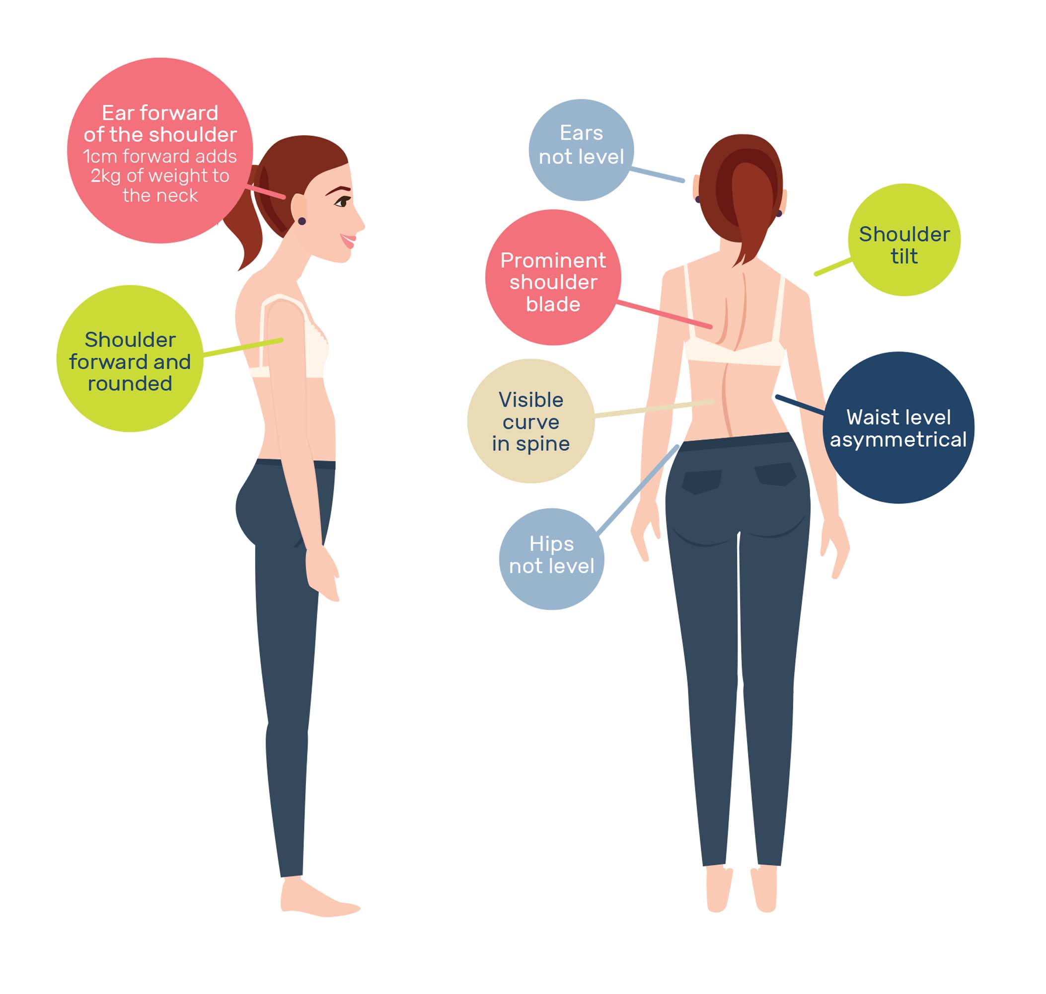 Adolescent Scoliosis